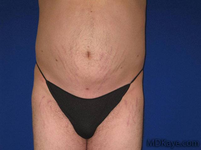 Liposuction for Men
