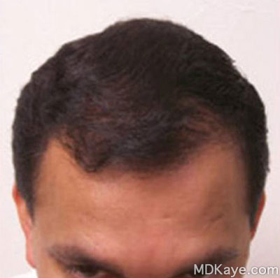 Neograft® Hair Restoration