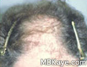 Neograft® Hair Restoration