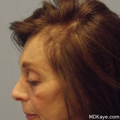 NeoGraft® Hair Restoration for Women
